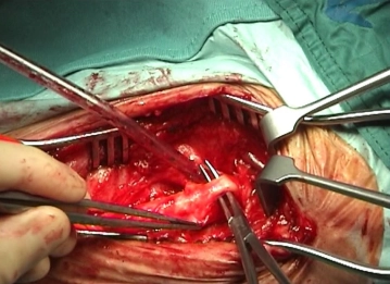 Präparation der Carotisbifurkation, Mobilisation des N. hypoglossus