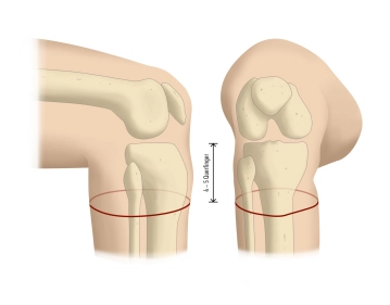 Hautinzision und Präparation eines Vollhautschlauchs
