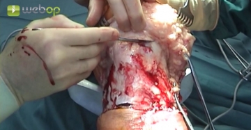 Durchtrennung des Lig. patellae, der Seitenbänder und der Kniegelenkkapsel medial und lateral