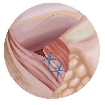 Hintere Hiatoplastik