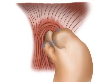 Fixation linker Fundus