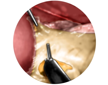 Anspannen des Magen und Inzision des Omentum minus