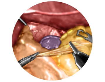 Mobilisation des Magenfundus