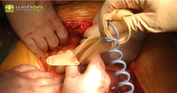 Lokalisieren der A. mesenterica superior