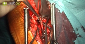 Infragenuale Freilegung der A. poplitea Abschnitt P III