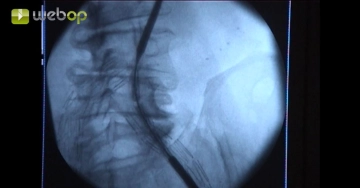 Einführen des Endograft-Trägersystems
