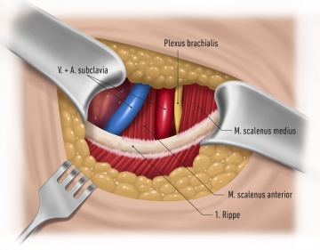 Darstellung der anatomischen Strukturen oberhalb der 1. Rippe