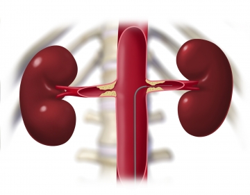 Intraoperative Angiographie, Sondierung der linken Nierenarterie