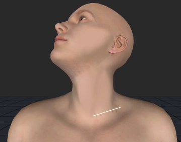 Zugang links supraclaviculär