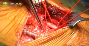 Präparation der Arteria carotis communis