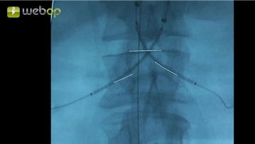 Implantation der renalen Chimney-Stent-Grafts