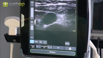 Duplex-Sonographie der Vena jugularis interna rechts, Lokalanästhesie