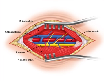 Präparation und Ausklemmen Arteria tibialis anterior