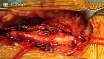 Präparation der Femoralisgabel linke Leiste