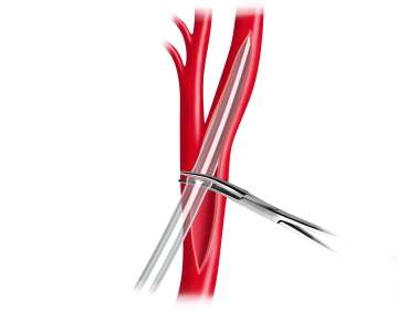 Intraluminale Shunteinlage