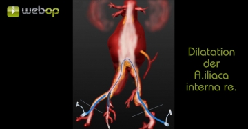 Crossover-Sondierung der rechten Arteria iliaca communis, Dilatation des rechten  Iliaca-interna-Abgangs 