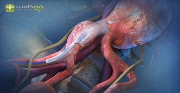 Partielle Entfaltung der iliakalen Branch-Komponente