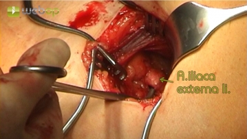 Extraperitoneale Freilegung der Arteria iliaca externa links, Punktion und Einbringen einer Schleuse nach Seldinger