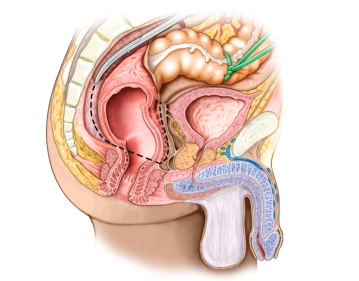 Dissecção retal anterior