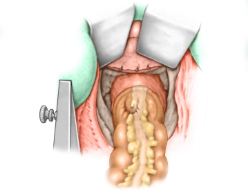Mesorektale Präparation