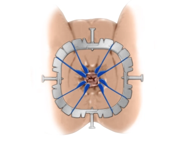 Anbringen des Retraktorsystems Lone Star; submuköse Unterspritzung im Analkanal 