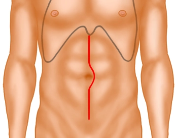 Laparotomie  und Exposition