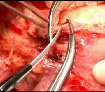 Ligatur A. gastrica dextra