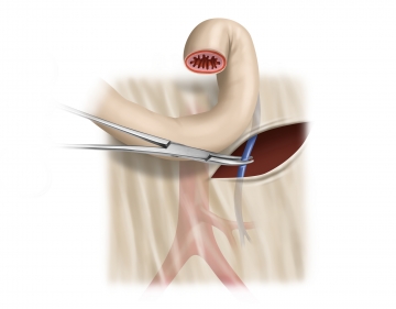 Versorgung der Vena mesenterica inferior