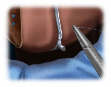 Refixation des Ligamentum teres hepatis