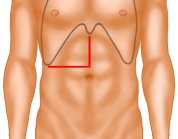 Laparotomie