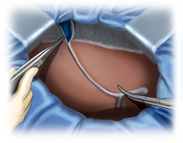 Durchtrennung des Ligamentum falciforme hepatis