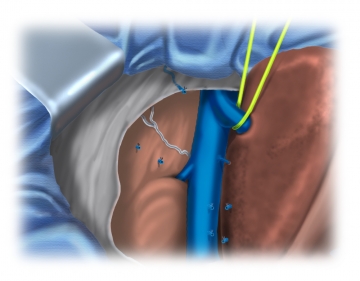 Präparation der Vena cava inferior