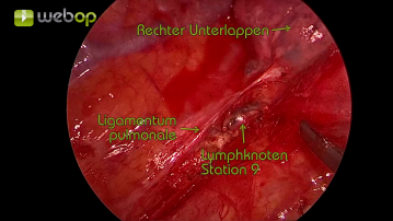 Exploration des Thorax und Präparation des Ligamentum pulmonale