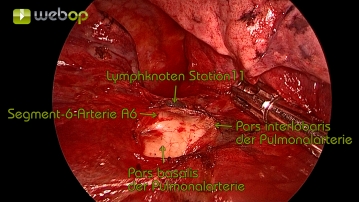 Präparation der Pulmonalarterie mit Darstellung der Segmentarterie A6