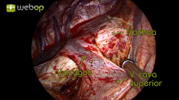 Präparation der Pleura mediastinalis oberhalb der Vena azygos