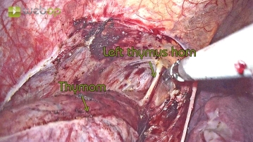 Darstellung des linken Thymus-Horns