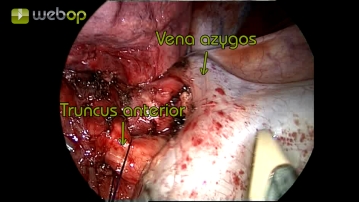 Resektion des Truncus anterior