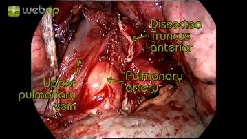 Dissektion der oberen Lungenvene