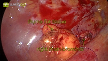 Deckung des Bronchusstumpfes