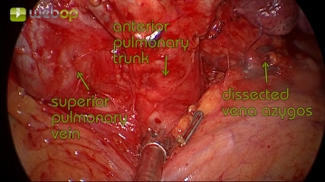 Präparation des Lungenhilus und der Pulmonalarterie