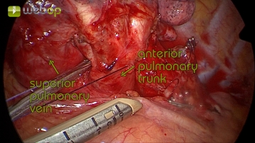 Dissektion des Truncus anterior der Pulmonalarterie
