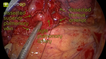 Resektion der zentralen Pulmonalarterie
