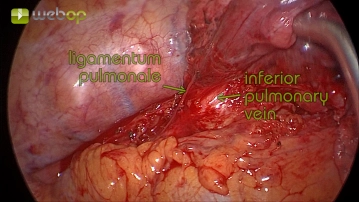 Präparation des Ligamentum pulmonale und der unteren Lungenvene