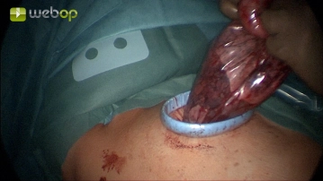 Bergung des Präparats