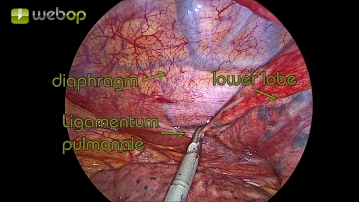 Präparation des Ligamentum pulmonale