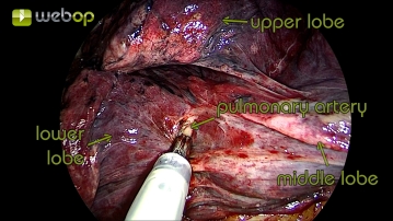 Präparation des Lappenspalts mit Darstellung der Pulmonalarterie