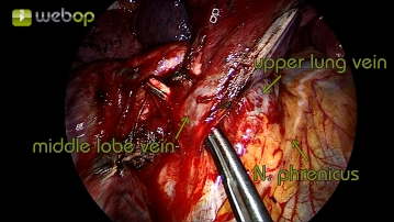 Präparation der Mittellappenvene