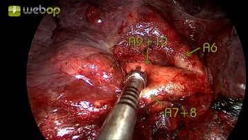Präparation der Pars basalis der Pulmonalarterie