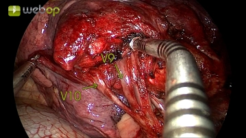 Absetzen der Segmentvenen V10 und V9