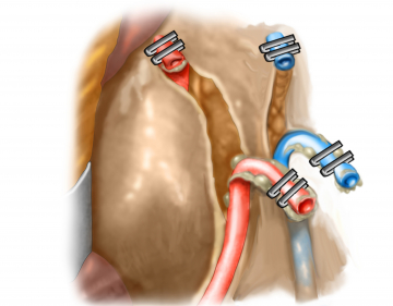 Stammnahes Absetzen der Arteria und Vena mesenterica inferior